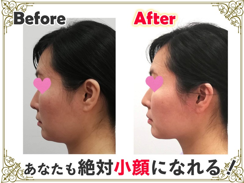 銀座 大手町の ハーブ温熱小顔矯正でお顔周りマイナス2cmも夢じゃない By 宗 冨美江 ストアカ