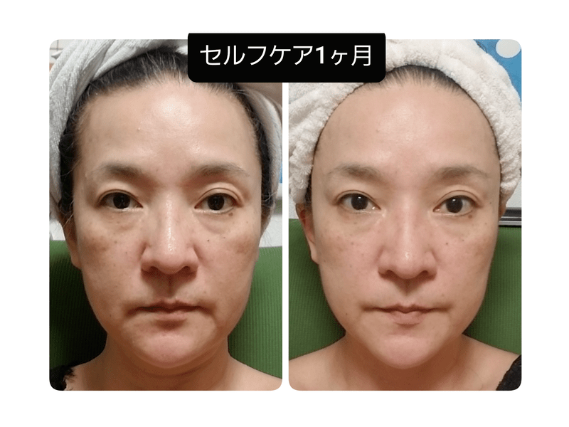 1日で激変！リフトアップ効果大、シワ大改善！